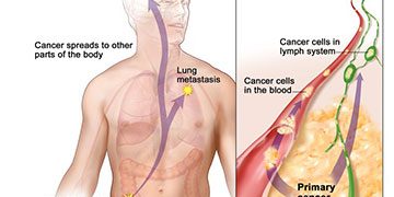 metastasis-article.__v30025841