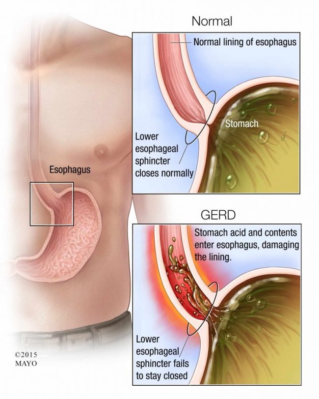 GERD-esophagus-820×1024