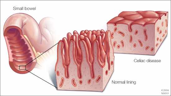 a-medical-illustration-of-a-normal-small-bowel-and-one-with-celiac-disease-16X9