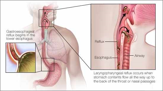 a-medical-illustration-of-gastroesophageal-reflux-and-layrngopharyngeal-reflux-original-1