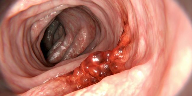 Colorectal cancer