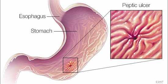a-medical-illustration-of-an-esophagus-stomach-and-peptic-ulcer-original