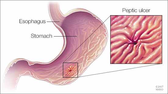 a-medical-illustration-of-an-esophagus-stomach-and-peptic-ulcer-original