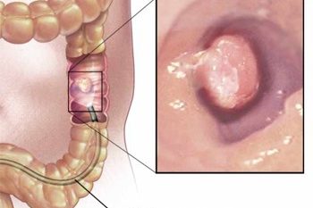 colorectal-cancer_large