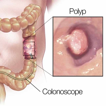 colorectal-cancer_large
