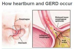 Γαστροοισοφαγική Παλινδρόμηση