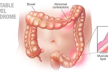 ibs