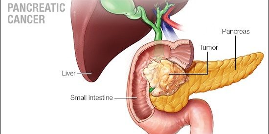 a-medical-illustration-of-pancreatic-cancer-16X9