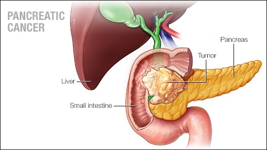 a-medical-illustration-of-pancreatic-cancer-16X9